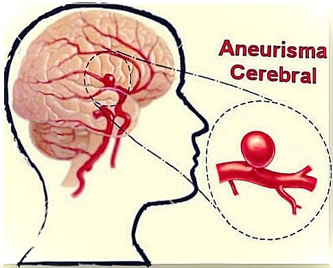 Cerebral aneurysm: definition, symptoms and treatments